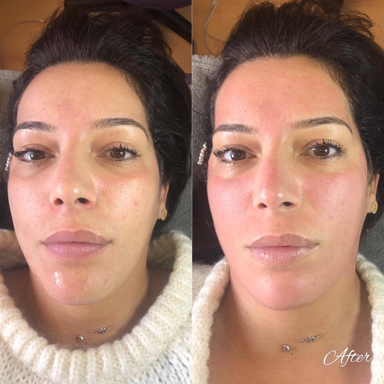 Microneedling bbglow