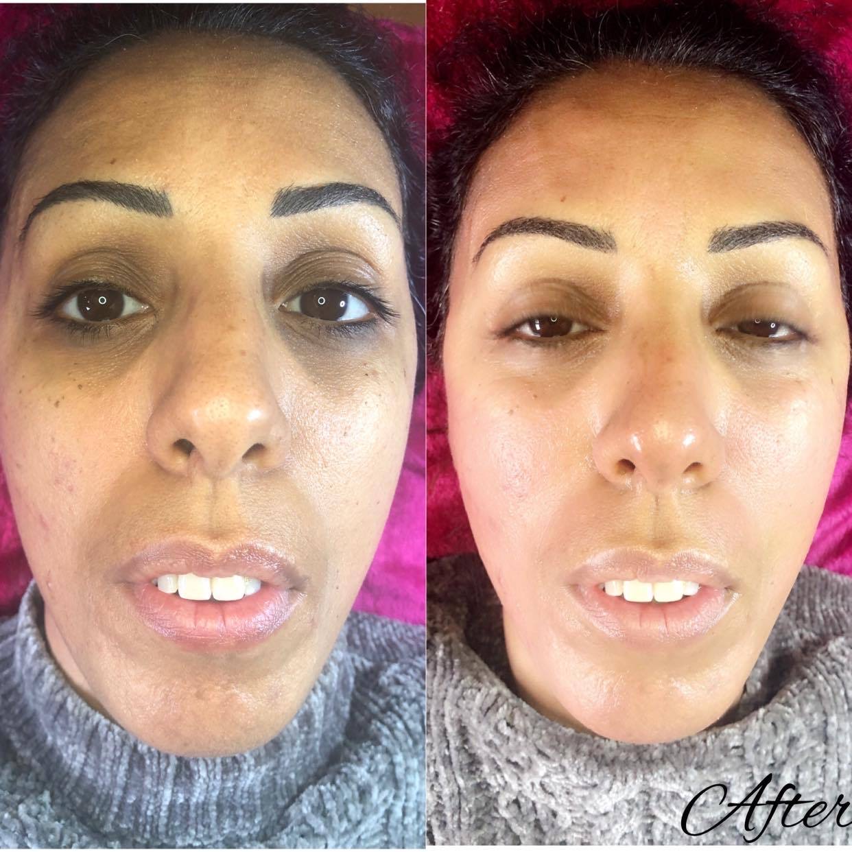 microneedling & bbglow (2)