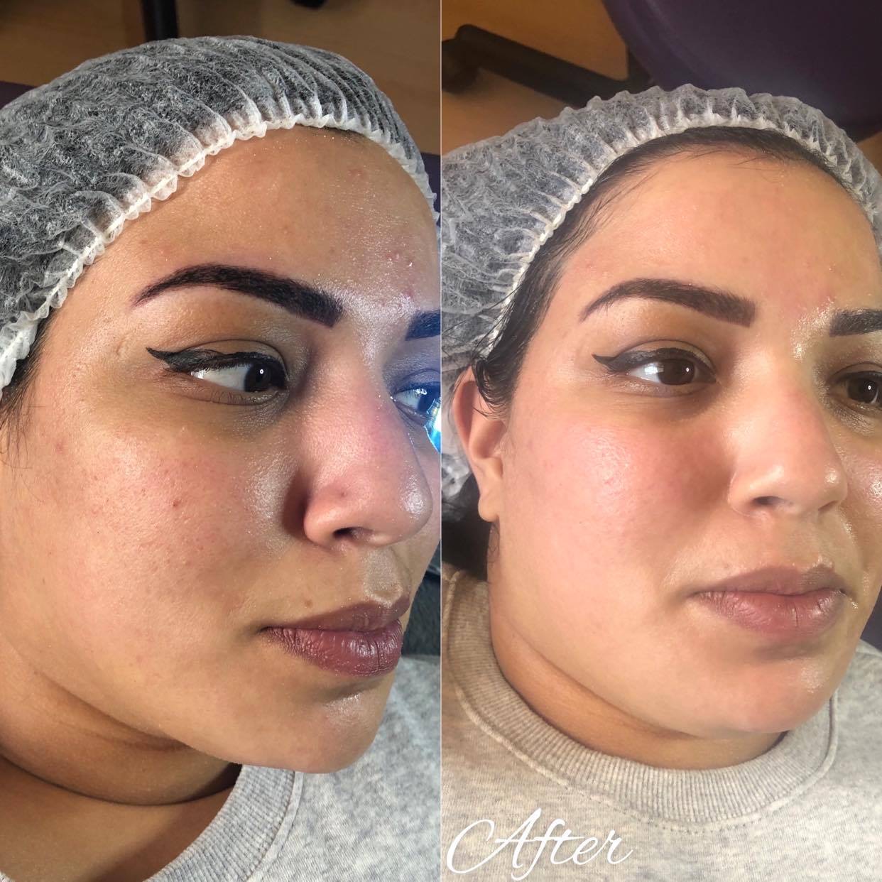 microneedling & bbglow (3)