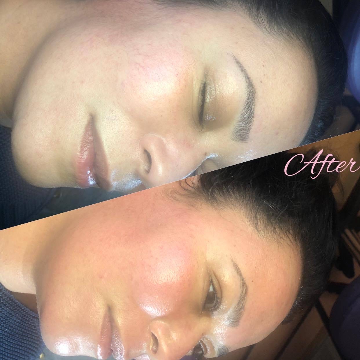 microneedling&bbglow